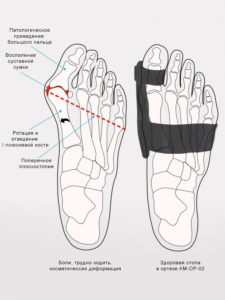 Ортез большого пальца ноги AM-OP-02